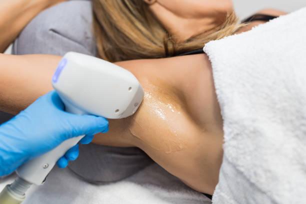 épilation laser à Villeurbanne épilation laser à Villeurbanne